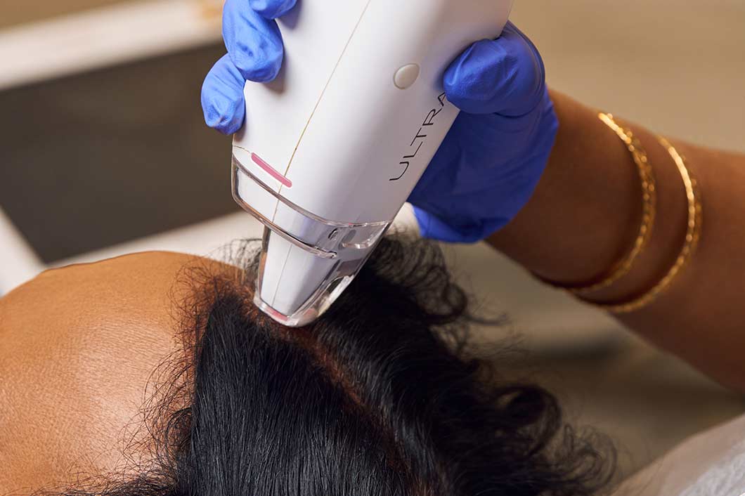 FUE Hair Transformations